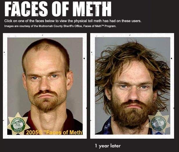 Why Meth Users Have Meth Sores and Scabs on Their Faces